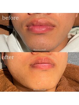 ピーディーエーサロン(PDA salon)/【脱毛の効果】