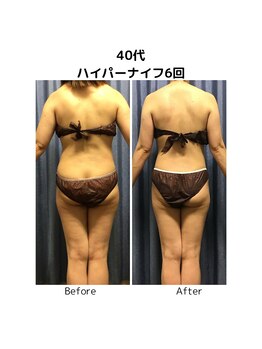 ビハダエステ 町田店(BIHADAエステ)/【B/A】40代ハイパーナイフ