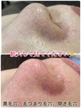 ビエル(Bielle)/開き、黒毛穴、産毛残りの方へ