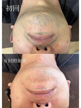 レーヌ(Reine)/メンズ人気NO１★ヒゲ脱毛
