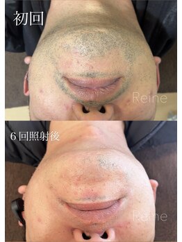 レーヌ(Reine)/メンズ人気NO１★ヒゲ脱毛