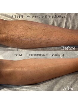 ソワン(Soin)/メンズ脱毛