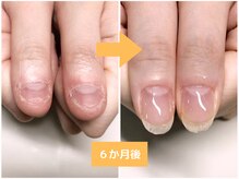 インブロッサム(imblossom)/深爪矯正/自爪育成