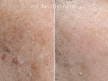 アート ビューティールーム(art beauty room)/☆OPL 光フェイシャル&オーダー 