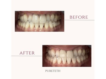 ピュアティス(PURETETH)/40代女性　before &after