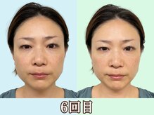 ナチュラルパーフェクトフェイス 新宿/6回目／４０代/新宿駅小顔矯正