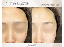 スリースリー 恵比寿(THREE THREE)/くすみ肌・透明感UP ケア