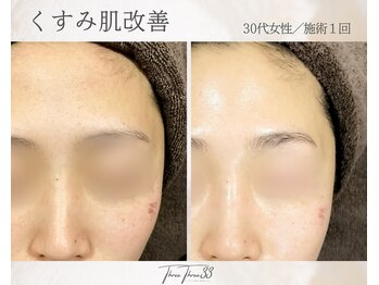 スリースリー 恵比寿(THREE THREE)/くすみ肌・透明感UP ケア