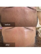 ナウ(now)/お顔のWAX脱毛＋炭酸ガスパック