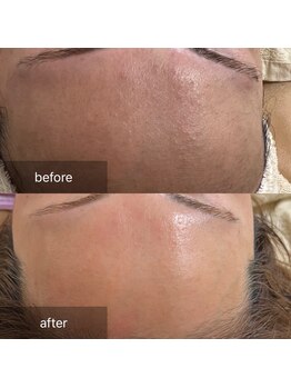 ナウ(now)/お顔のWAX脱毛＋炭酸ガスパック