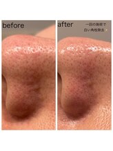 セラピーラボ(Therapy Lab)/【美容】最新毛穴洗浄エステ♪