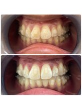 エクシアホワイトニング 日本橋店/矯正中でも