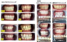エクシアホワイトニング 盛岡中央通店