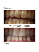ホワイトニングショップ 熊谷店/【ヤニ汚れもスッキリ！】