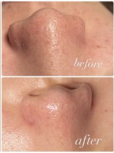 雅菜(miyabina)/ハイドラ毛穴洗浄　毛穴美人へ