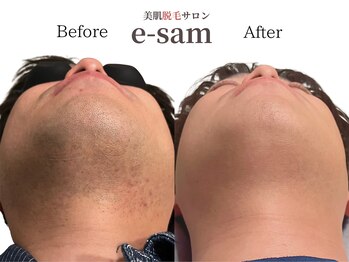 イーサム 高槻摂津富田店(e-sam)/髭脱毛