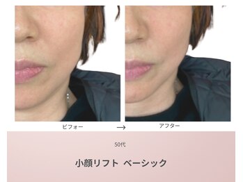 リアン(Lien)/50代 ビフォーアフター