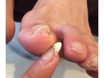 エムクチュール/爪のトラブルケア