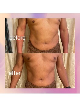 サンサンゴビューティー(335beauty)/余分な脂肪とさよなら◎