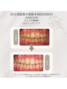 プラスビーセルフ(+b self)/30分連続照射＊ホワイトニング