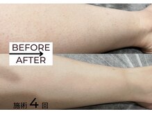 ベガ(Vega)/レディースLED脱毛