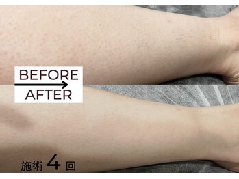 ベガ(Vega)/レディースLED脱毛