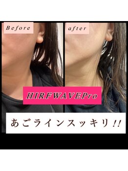 ティアメディカル(Tia Medical)/HIRFWAVEPro