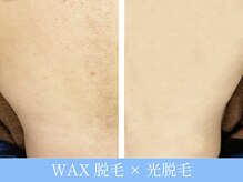 オーシャンブルー 大分店(OCEAN BLUE)/ワックス脱毛×光脱毛