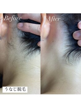 アース コアフュールボーテ 新潟紫竹山店(EARTH coiffure beaute)/うなじ脱毛