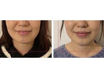 ルポアミ 代々木上原(REPOS AMI)/ヘッドスパ×小顔矯正 3回の変化