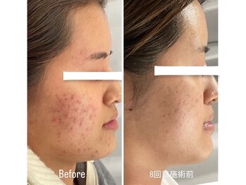 ヒジ(Life Salon)/お顔ハーブピーリング