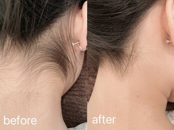 ルナベル(Luna Bell)/脱毛：うなじ