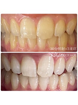 ホワイトニングルーム 横浜店(Whitening Room)/ホワイトニング/横浜
