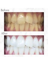 エクシアホワイトニング 天神店/ホワイトニングビフォーアフター