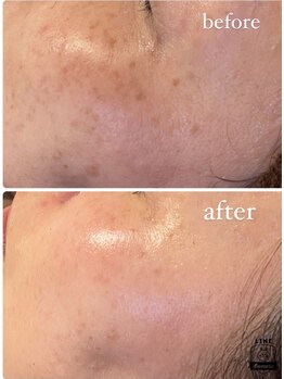 雅菜(miyabina)/シミ・くすみケア　肌質改善