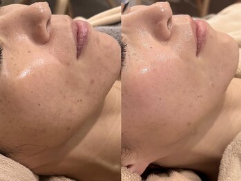 シュリー(Sriii)/ワイコ水光ピールでハリUP♪