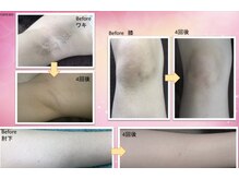 中国整体リラクゼーション 桜月/脱毛効果