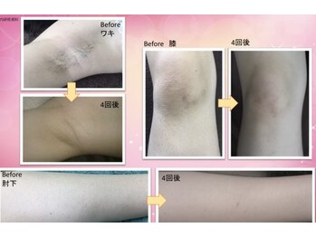 中国整体リラクゼーション 桜月/脱毛効果