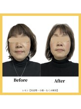 美容整体 レモン/フェイスラインすっきり