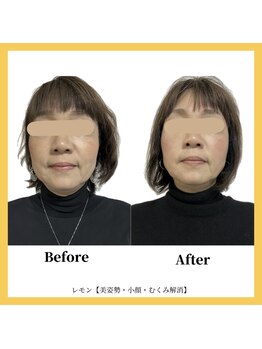 美容整体 レモン/フェイスラインすっきり