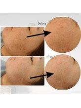 リル(RIRE)/リブセラフェイシャル