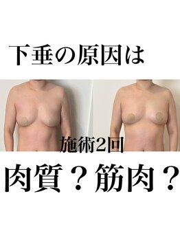 サロンツキ(salon tuki)/【バストケア】症例