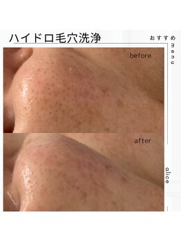 アリス(Alice)/ハイドロ毛穴洗浄