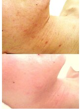 サロンドエステケイワイ(de KY)/フェイシャル☆ニキビ改善