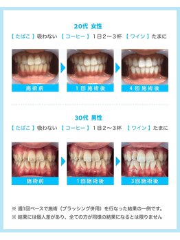 ホワイトニングカフェ 豊中店(WhiteningCafe)/◎歯のホワイトニング施術写真◎
