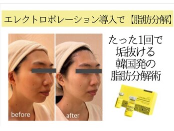 クリニカルエステ/イーズ 六甲アイランド店/20～30代　小顔むくみ