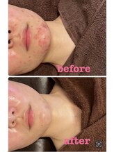 雅菜(miyabina)/しつこい…ニキビケア　肌質改善