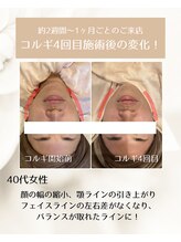 エステサロン アニー(ANNIE)/小顔コルギビフォーアフター