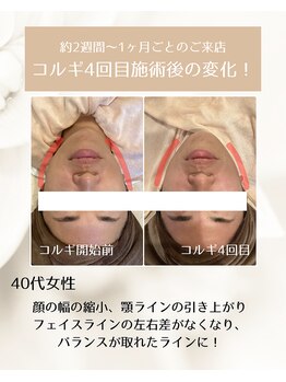 エステサロン アニー(ANNIE)/小顔コルギビフォーアフター