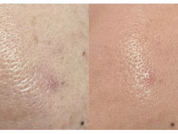 クリニカルスイート エーアール(Clinical sweet.ar)の写真/ファンデーションが落ち込む毛穴に、もう悩まない。頬のたるみ毛穴を集中ケア。